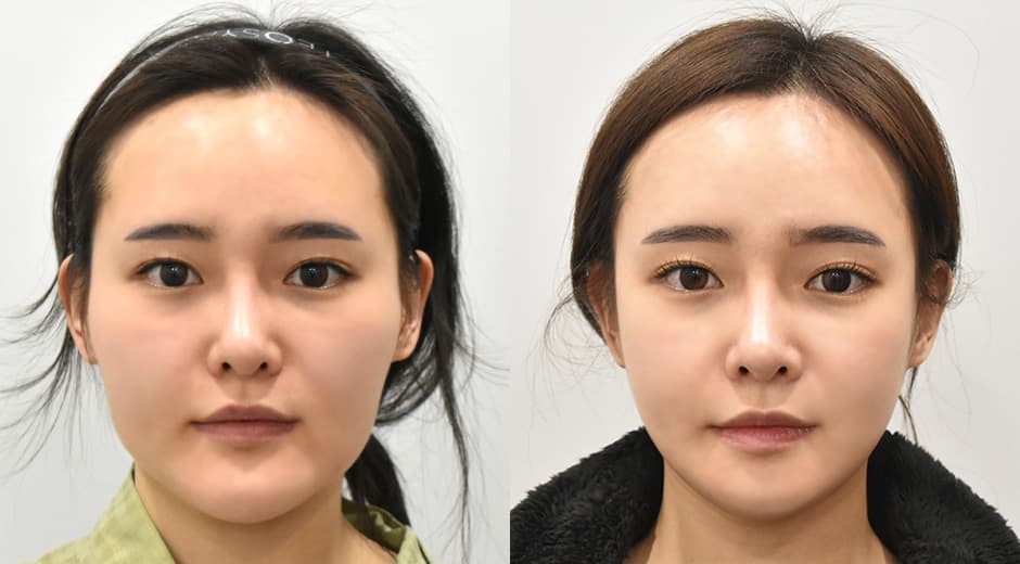 下巴縮小 顴骨 下顎角