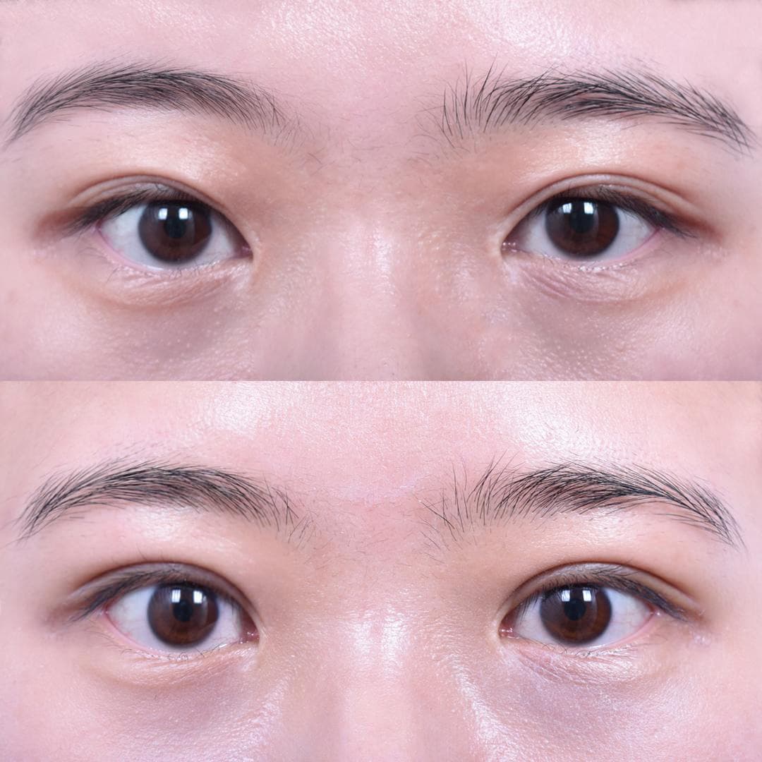 非切開眼型矯正(1個月後)