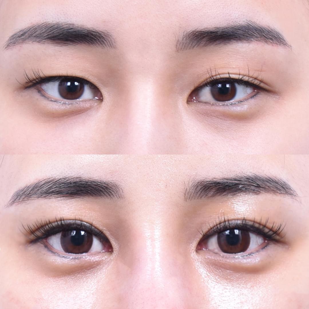 縫雙眼皮(2週後)