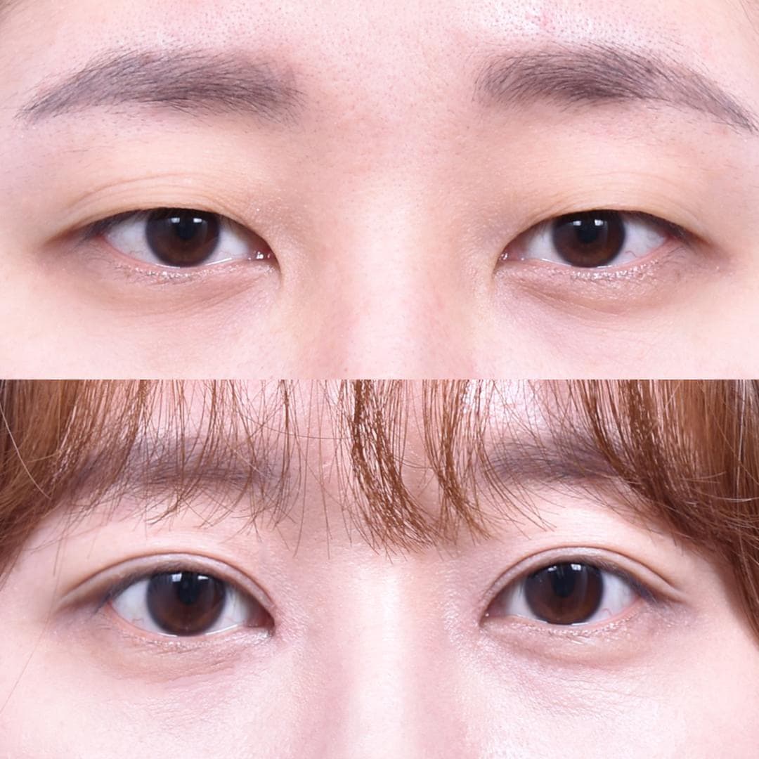 非切開眼型矯正 + 上眼角開大(1個月後)