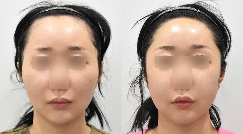 縮小顴骨 縮小額頭