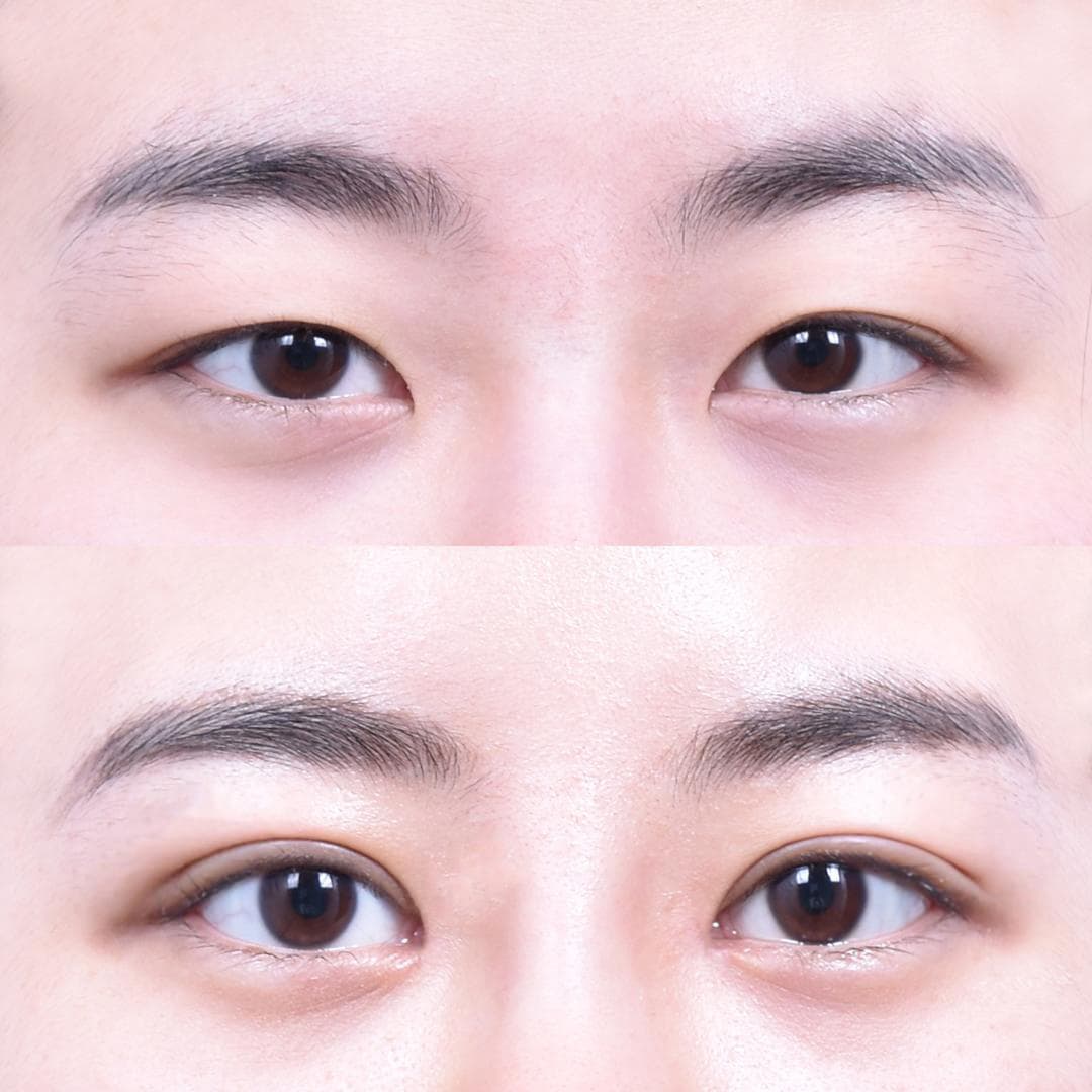 非切開眼型矯正 + 前眼角開大 + 上眼角開大(3週後)