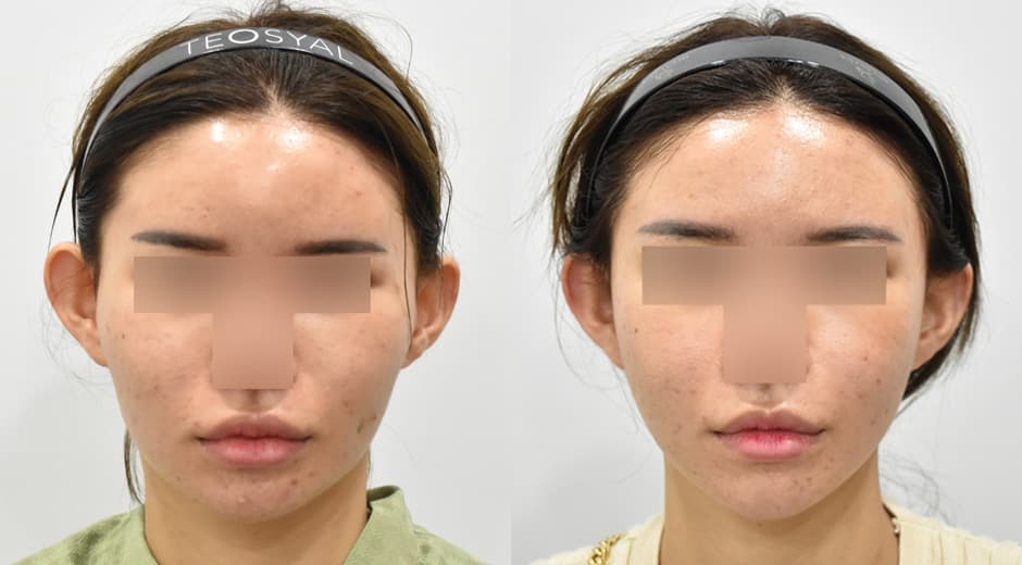 縮小顴骨 縮小方形下顎