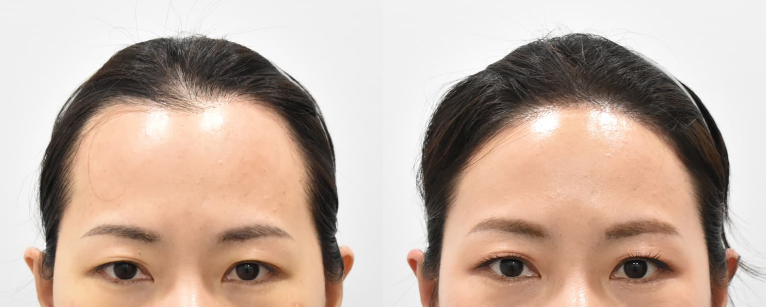 縮小額頭 M字髮際線植髮
