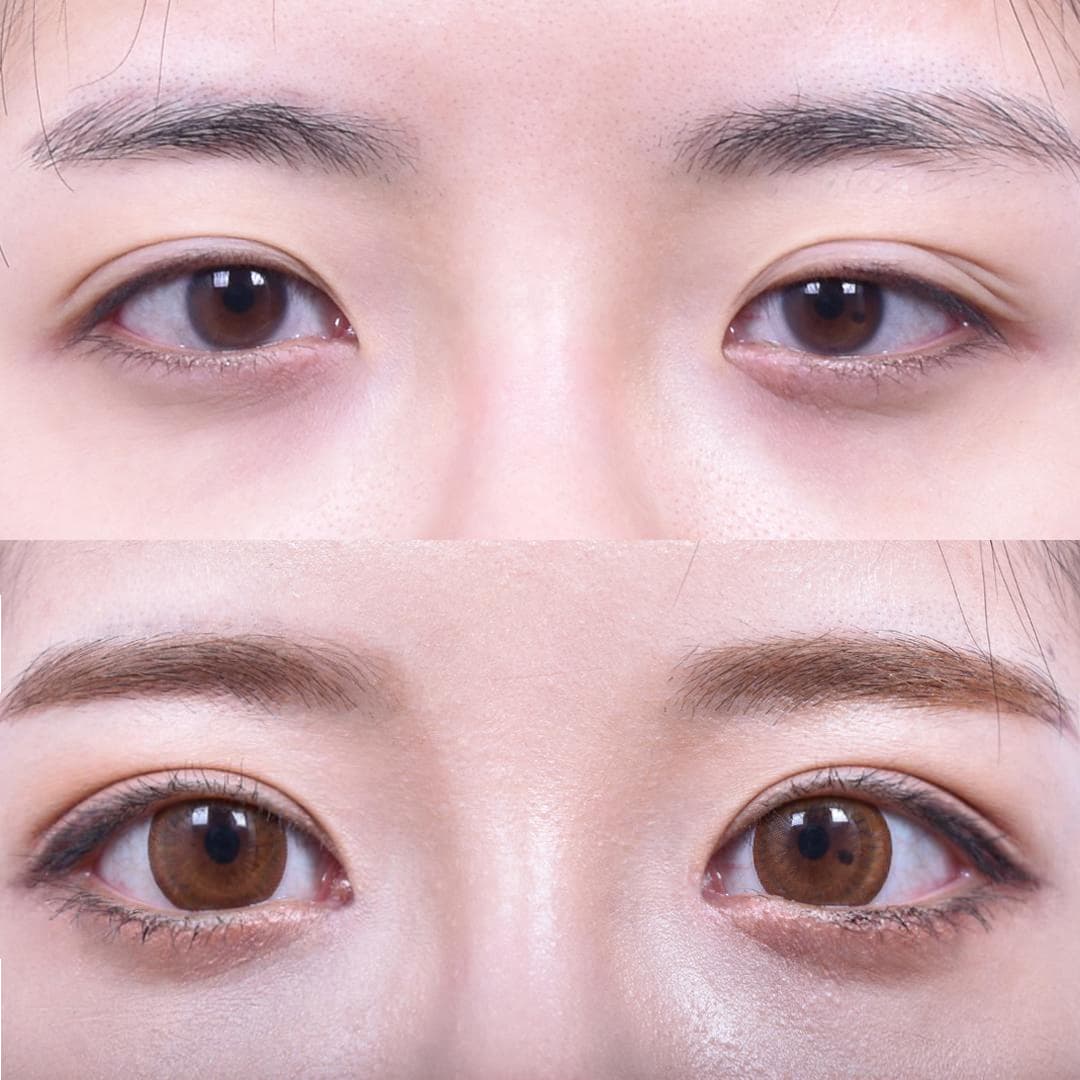 非切開眼型矯正 + 前眼角開大 + 後眼角開大(3個月後)