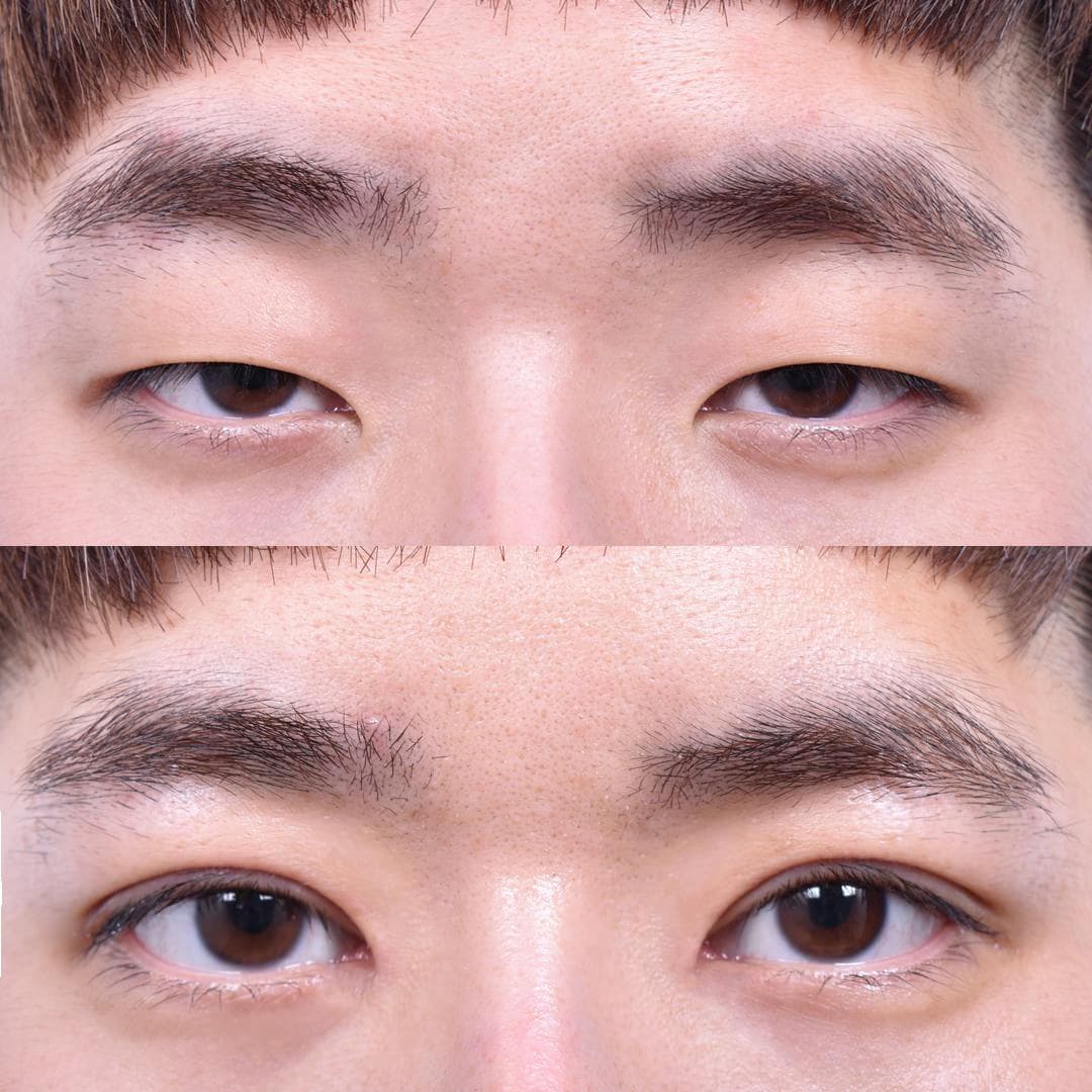 非切開眼型矯正 + 前眼角開大(1週後)