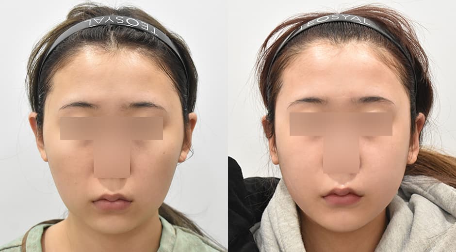 前下顎前突 顴骨縮小