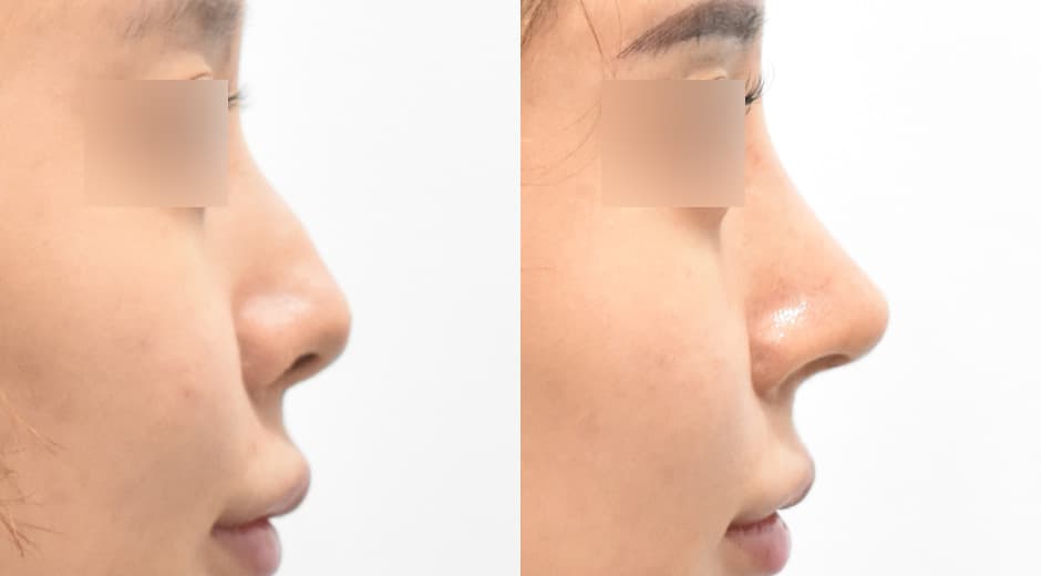 人中鼻(第一次手術)