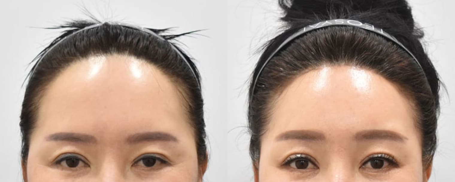 縮小額頭 額頭提升