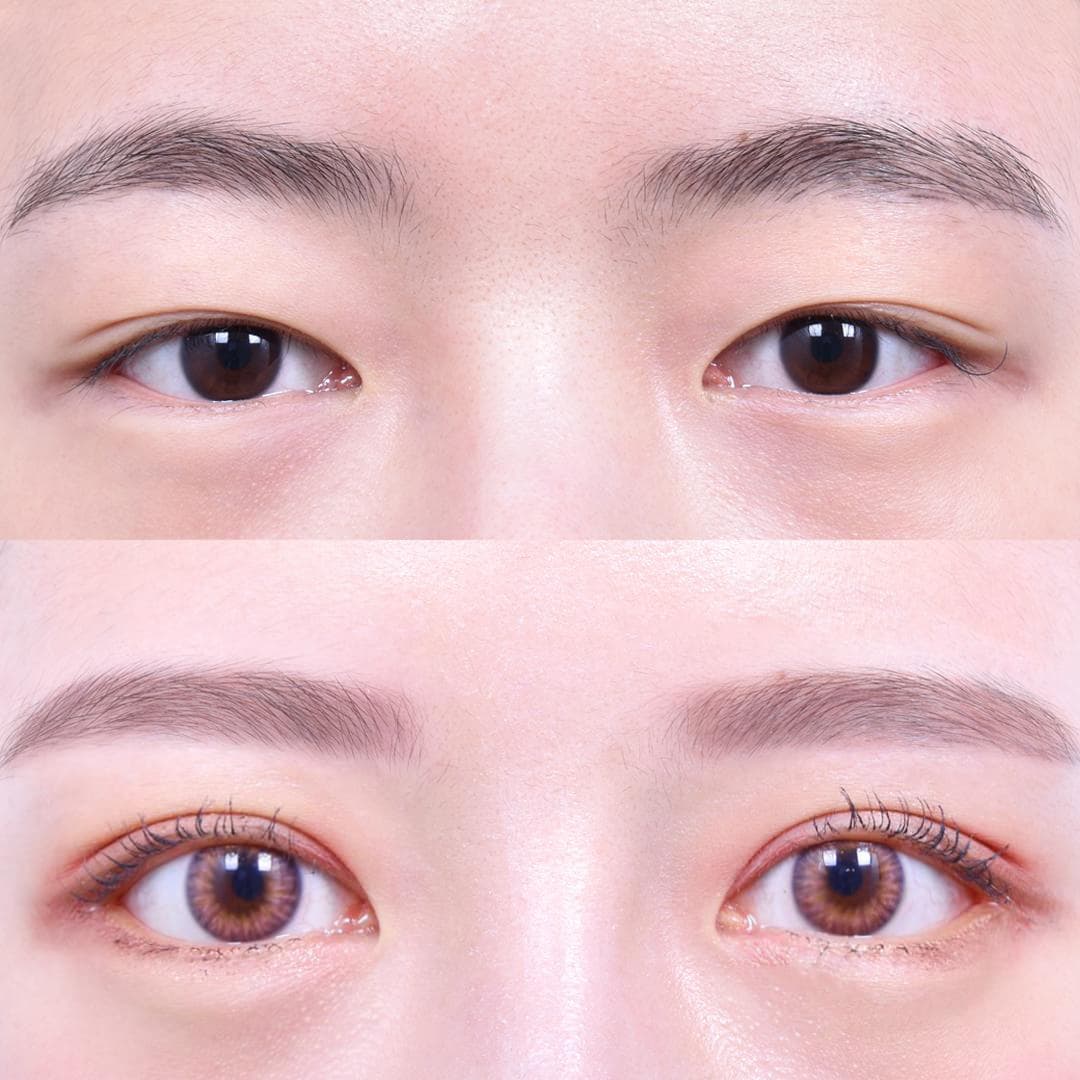 眼型矯正 + 眉下提升 + 後眼角開大 + 下眼角開大(1個月後)