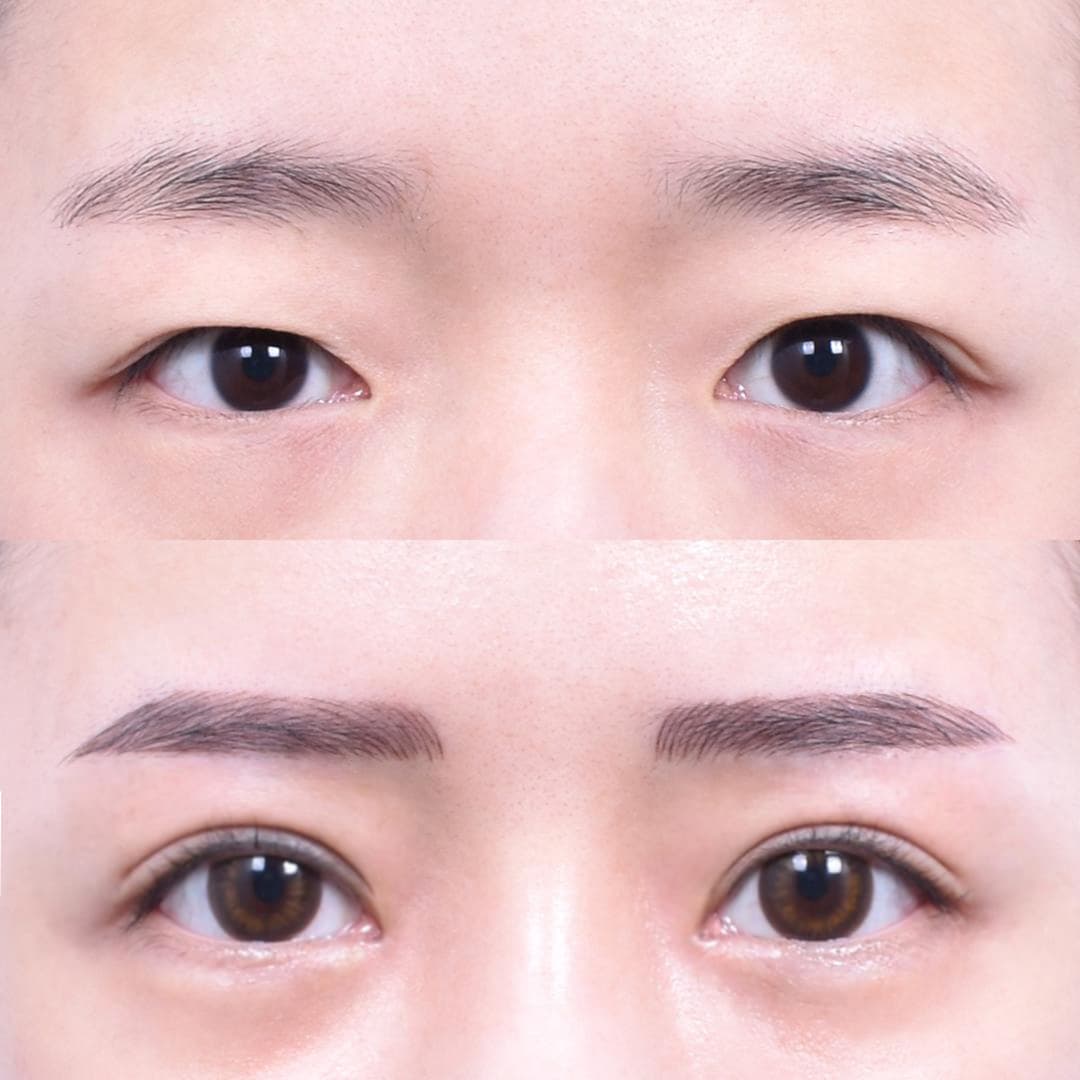 眉下提升 + 非切開眼型矯正 + 前眼角開大(1個月後)