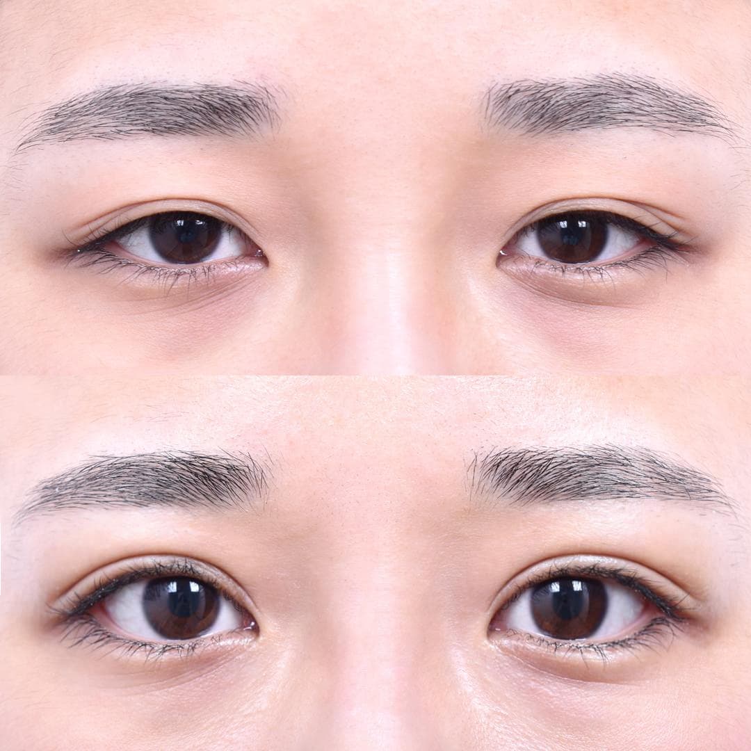 部分切開眼型矯正(1個月後)