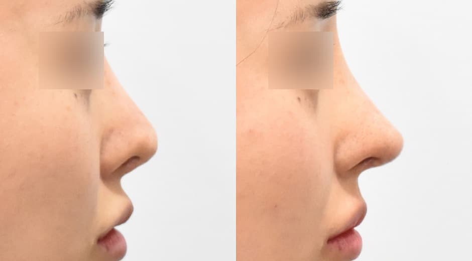 人中鼻(二次修復手術)