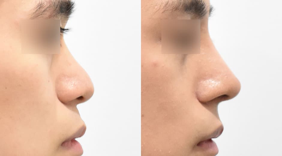 人中鼻(第一次手術)