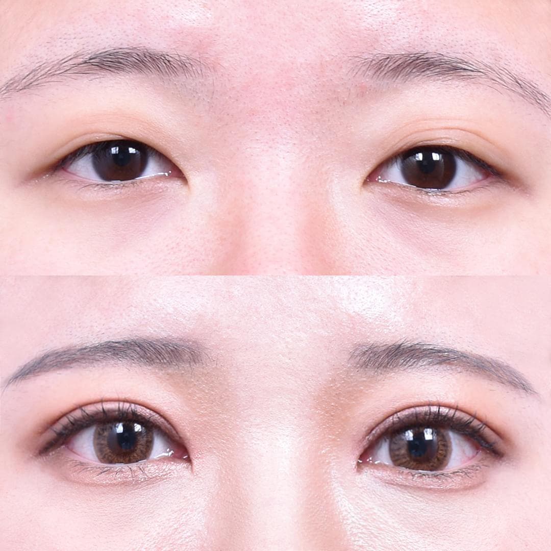 非切開眼型矯正 + 上眼角開大(1個月後)