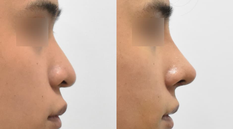 人中鼻(第一次手術)